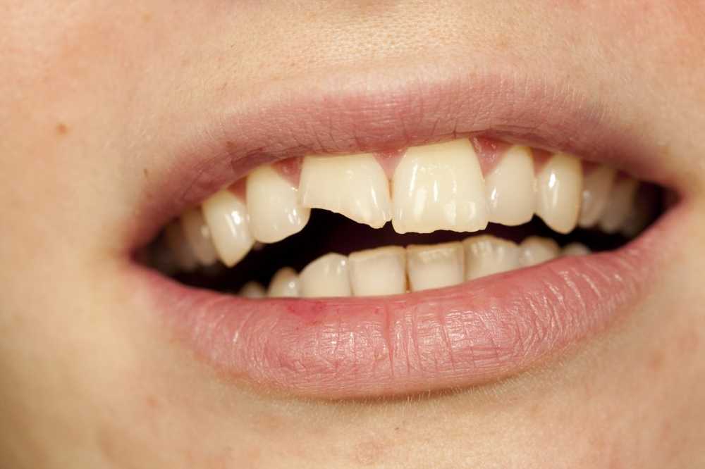 Chipped tooth - causes and therapy