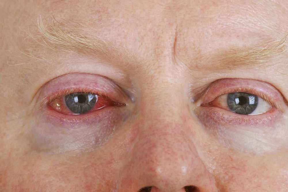 Attention Aggressive conjunctivitis spreads - so protect yourself from eye flu / Health News