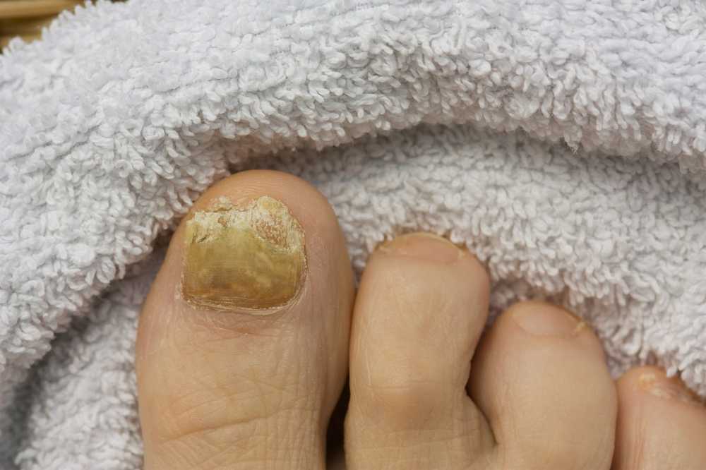 Attention This skin cancer can mimic a nail fungus / Health News