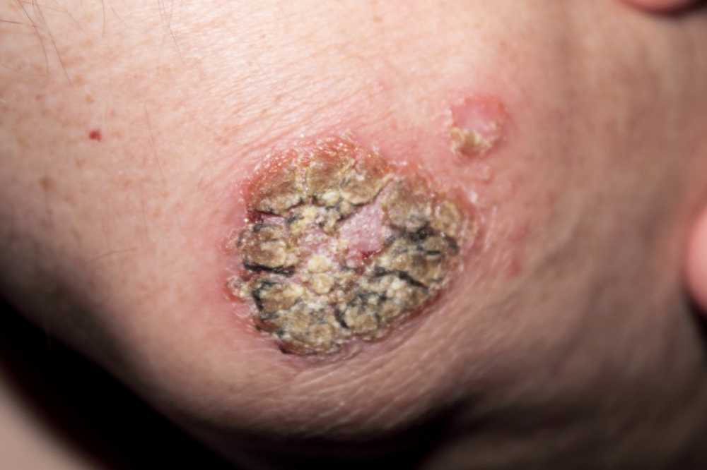 Attention Scaly areas of skin can be a sign of skin cancer / Health News