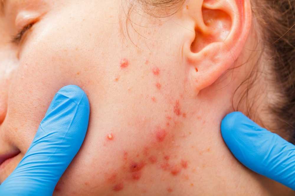 Acne van 30 puistjes pest veel volwassenen - Beter niet uitdrukken! / Gezondheid nieuws