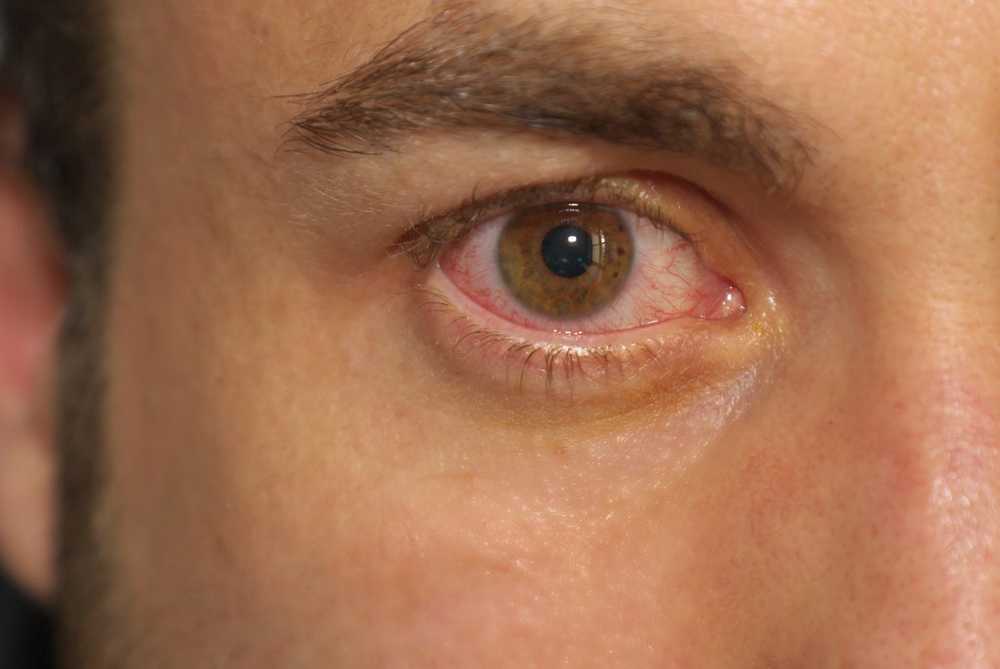 Eye herpes causes, treatment and home remedies / Diseases