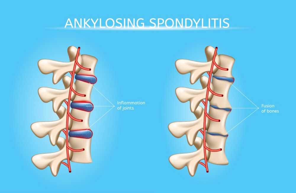 Autoimmuna sjukdomar Nya resultat på ankyloserande spondylit / Hälsa nyheter