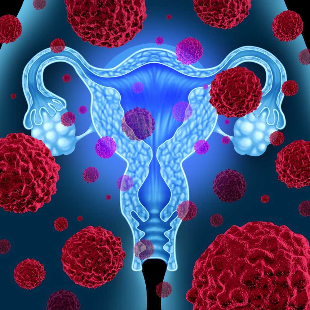 Breakthrough breakthrough virus allows new therapy for ovarian cancer / Health News