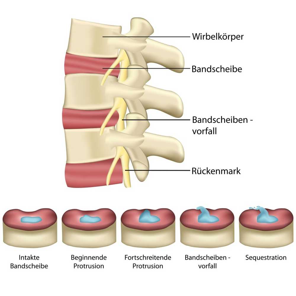 Intervertebral discs A natural but slightly susceptible buffer in the back / Health News