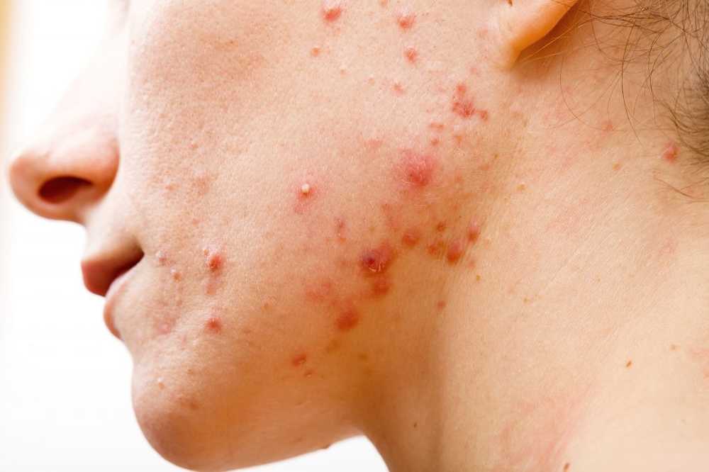 Bij acne Welke therapieën helpen eigenlijk? / Gezondheid nieuws