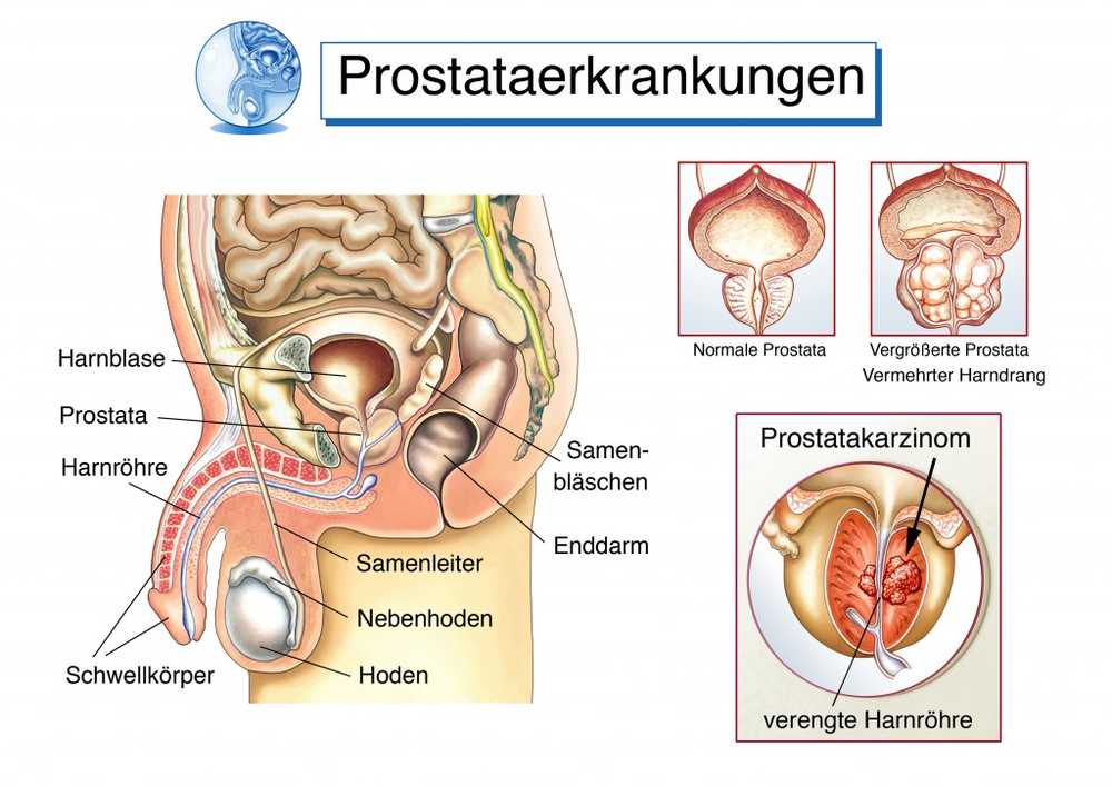 Ongemak bij het urineren (blaas lediging stoornis)