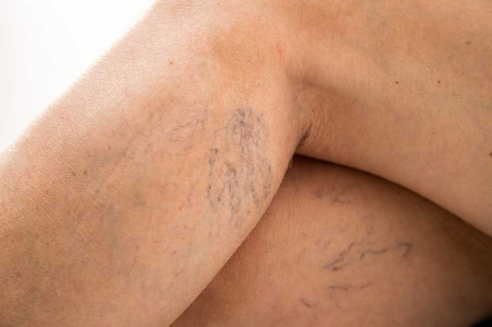 Spider veins causes, home remedies and prevention / Diseases