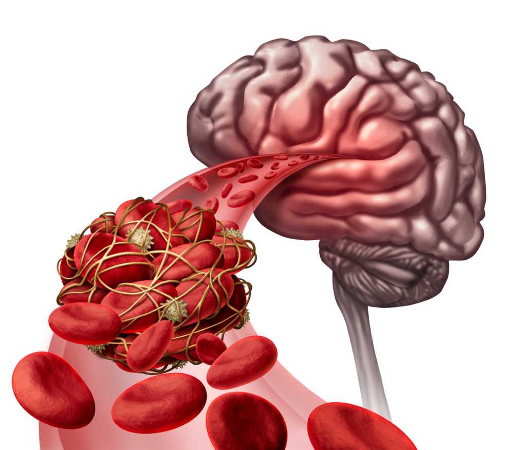 Blood clots in the head - symptoms, cause and therapy / symptoms