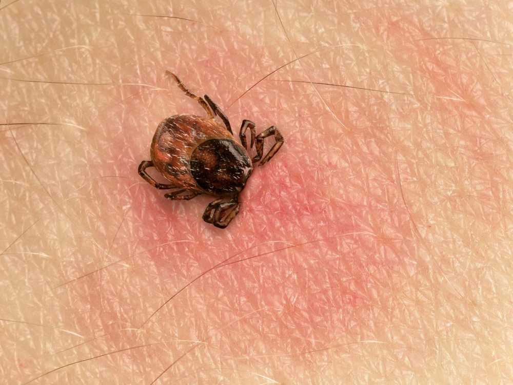 Maladie de Lyme Mauvaise paralysie faciale causée par une morsure de tique? / Nouvelles sur la santé