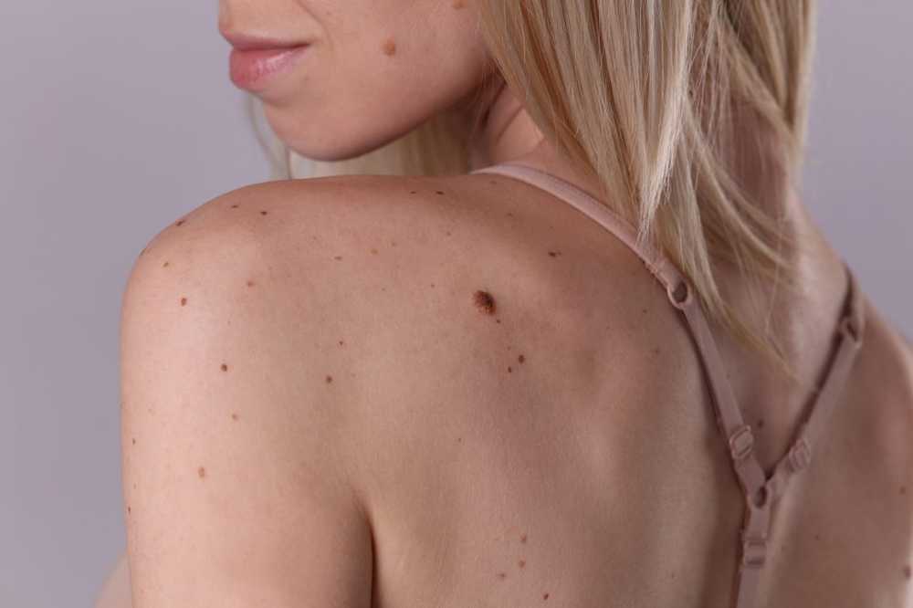 Brown spots on the skin causes and treatment