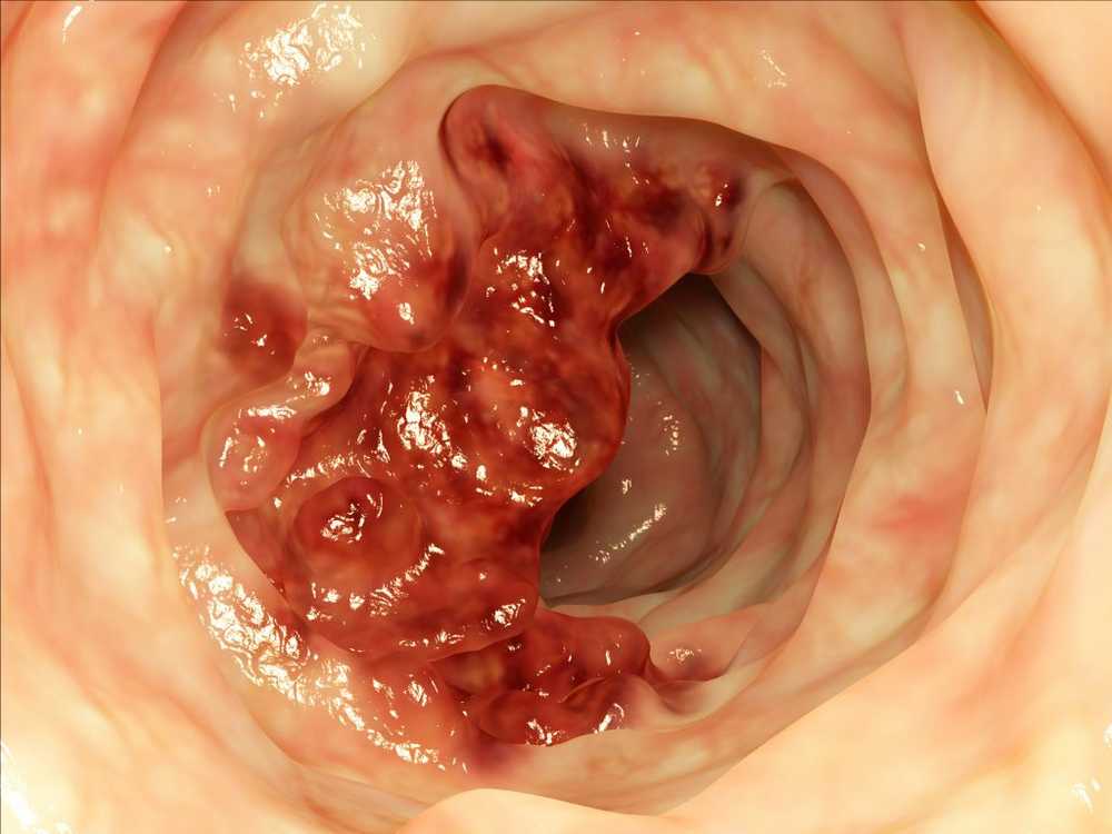 Hoog cholesterolgehalte bevordert de vorming van tumoren / Gezondheid nieuws