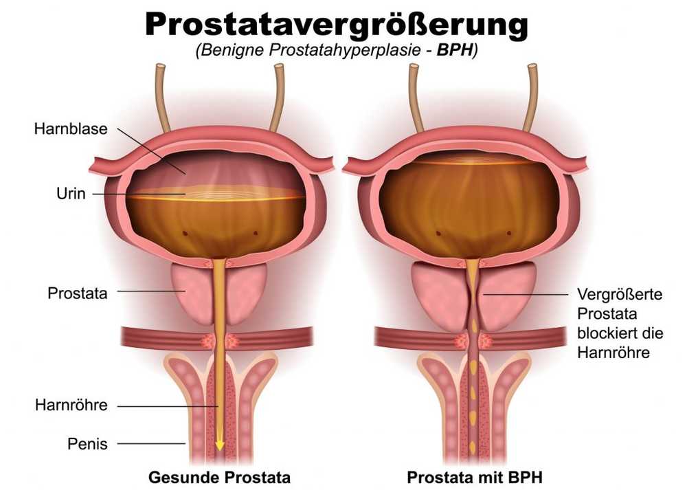 Steam therapy causes enlarged prostate to shrink in a timely manner / Health News