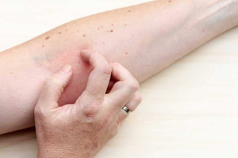 The scabies spread more and more - so you can protect yourself / Health News