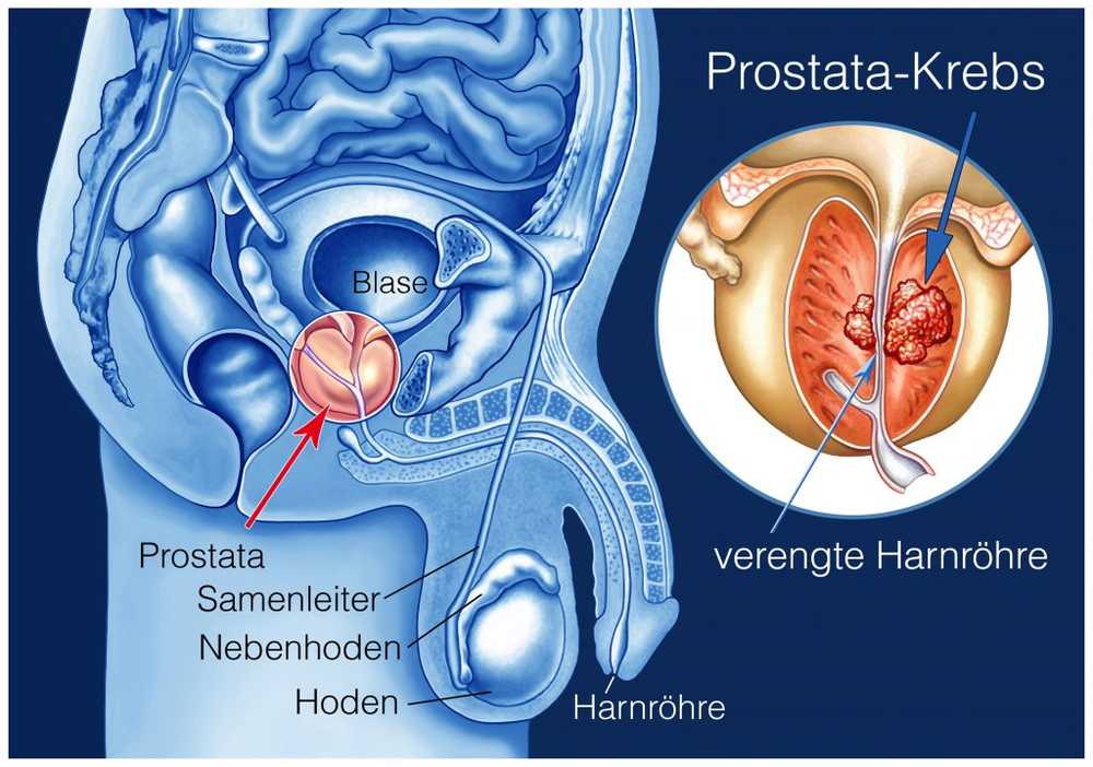 Dette er de 10 viktigste symptomene på prostatakreft / Helse Nyheter