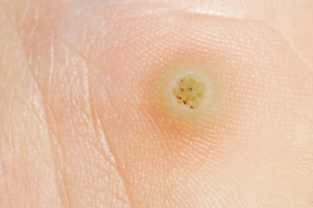 Plantar warts - causes, treatment and home remedies / Diseases