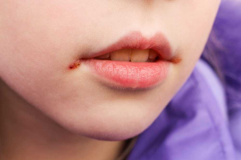 Torn corners of the mouth - causes, treatment and home remedies