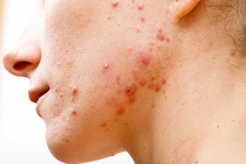 Pus Pimple Express or leave standing? / Health News