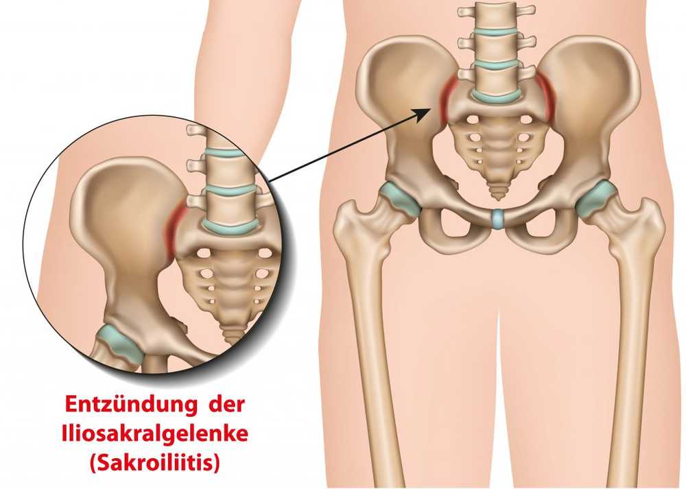 Ontsteking en pijn Spondylitis ankylopoetica heeft ook invloed op vrouwen / Gezondheid nieuws