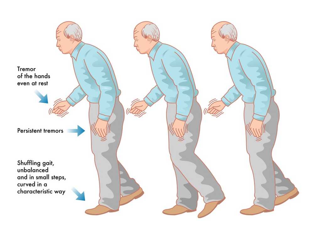 Researches Parkinson's Disease in the stomach? / Health News