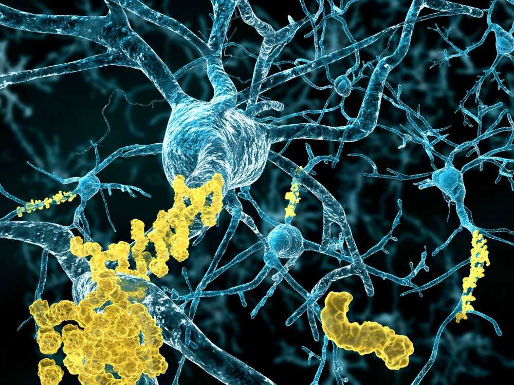 Researches new antibody drug against Alzheimer's / Health News