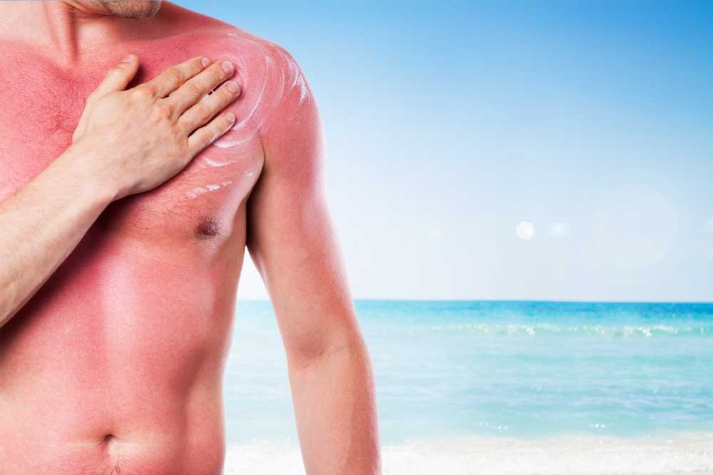 First aid after sunbathing Emergency measures for sunburn / Health News