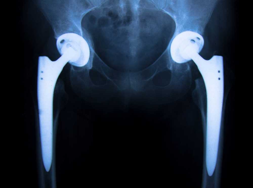 Research Health risks due to released nanoparticles from hip prostheses