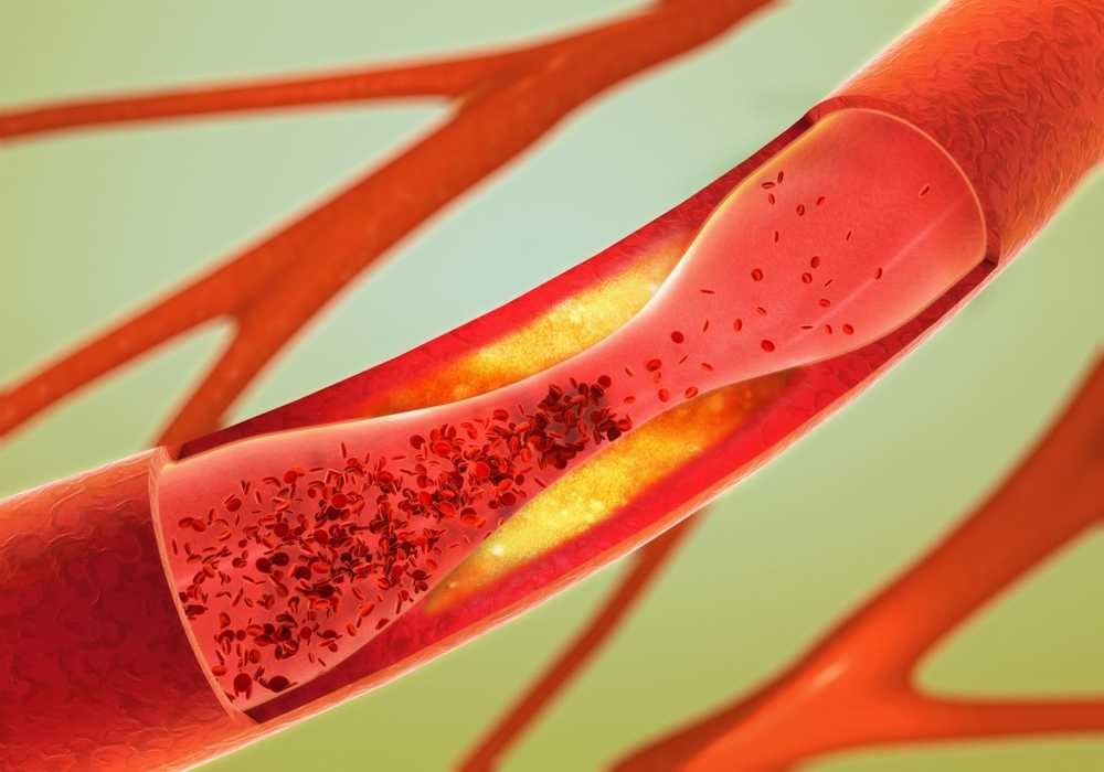 Against Arteriosclerosis Will there be no clogged arteries soon? / Health News