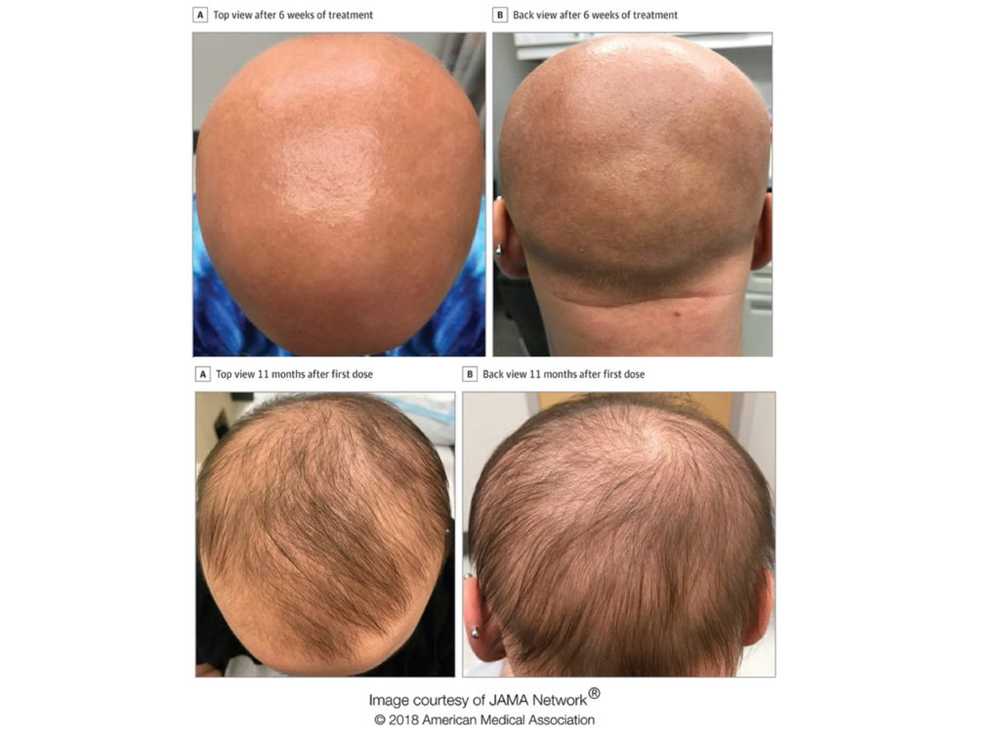 Against the bald eczema drug allows lost hair to regrow / Health News