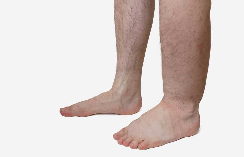 Swollen feet causes and treatment