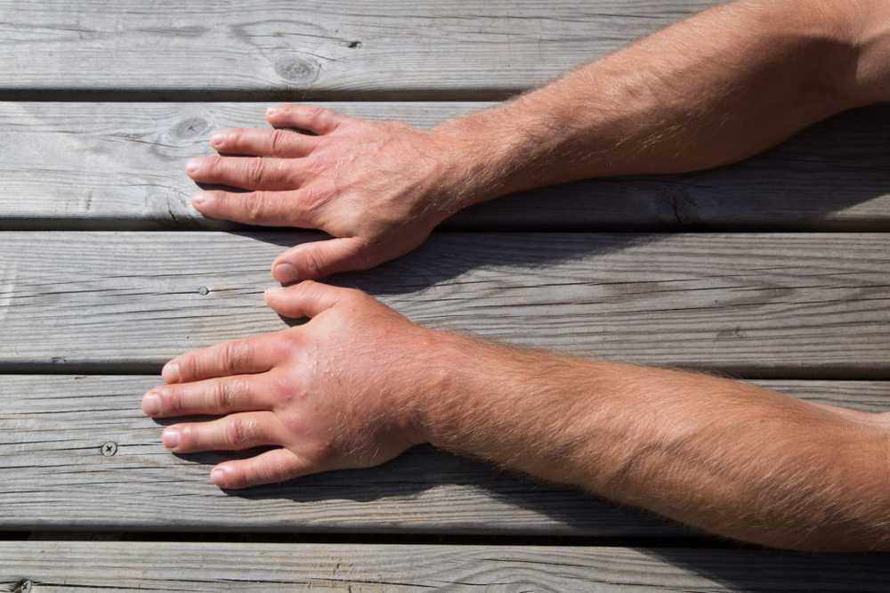 Swollen hands - causes, diagnosis and treatment