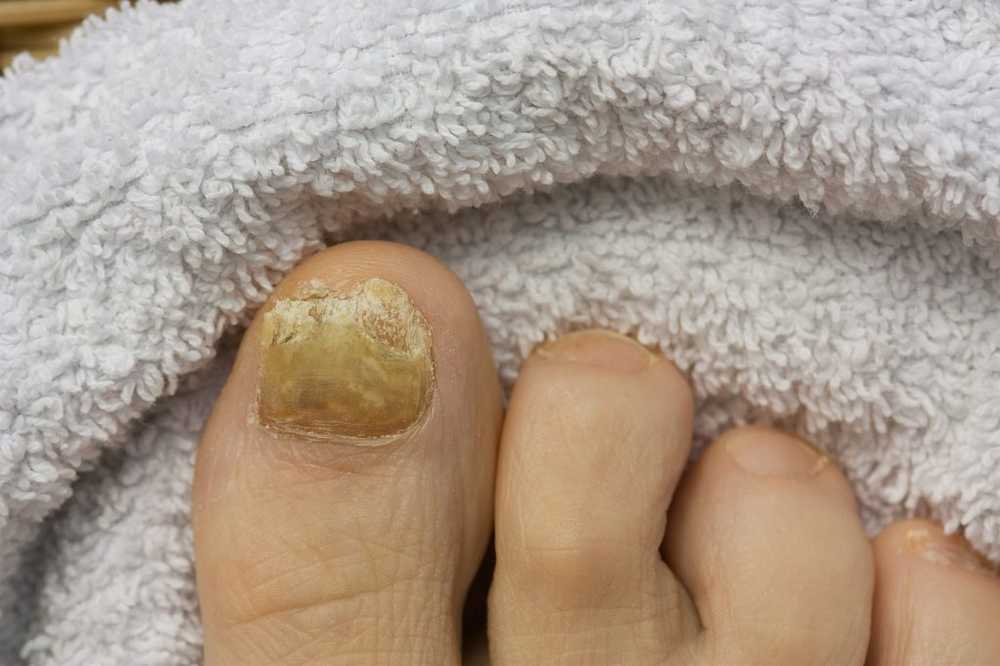 Health This can actually help against stubborn nail fungus / Health News