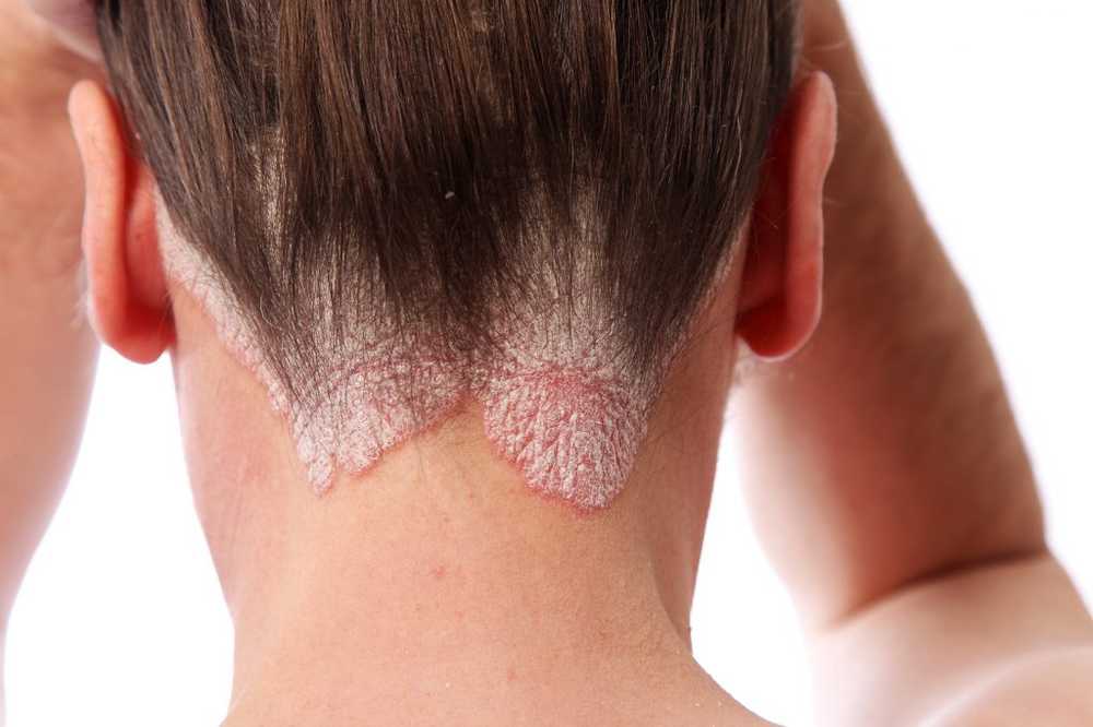 Health psoriasis often with serious accompanying diseases / Health News