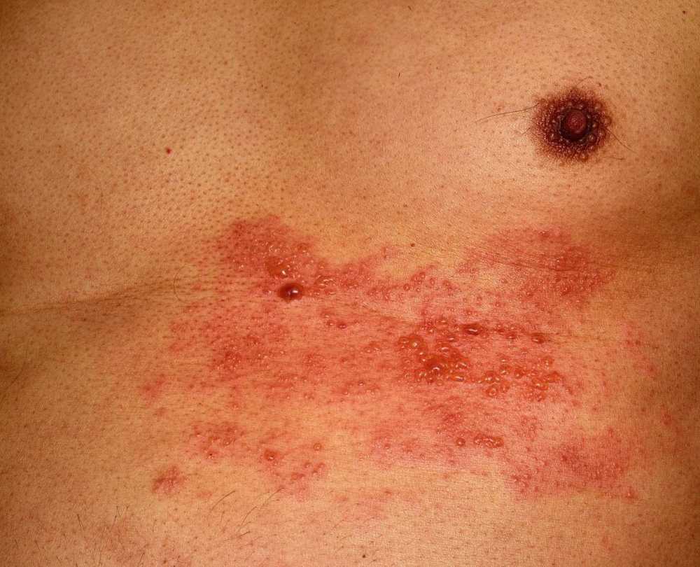 Shingles Questi sono i primi sintomi l'azione rapida è importante! / Notizie di salute