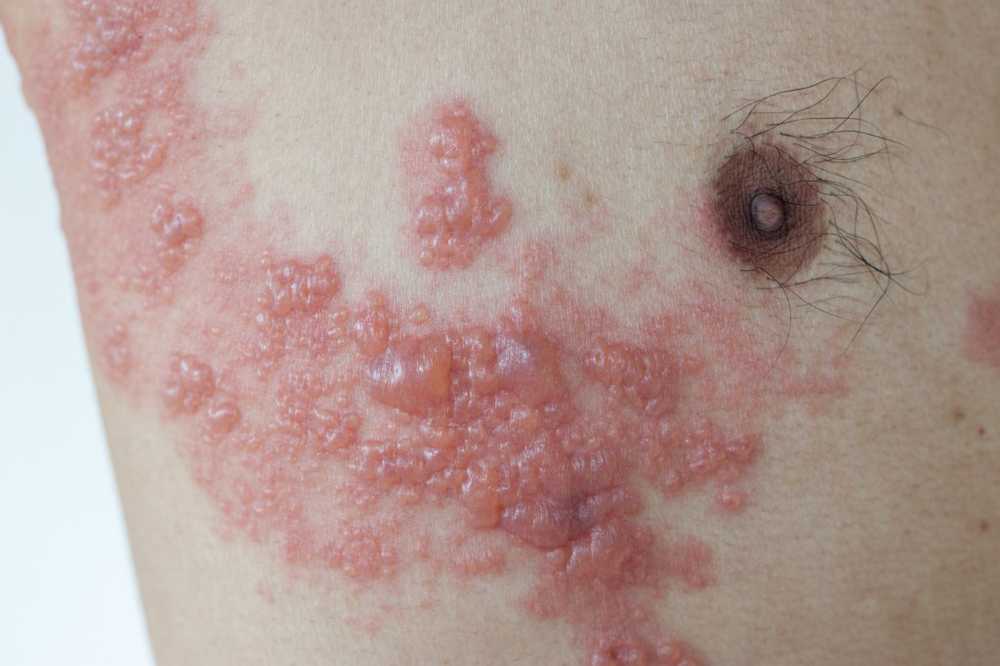 Sintomi di herpes zoster correttamente e agire rapidamente / Notizie di salute