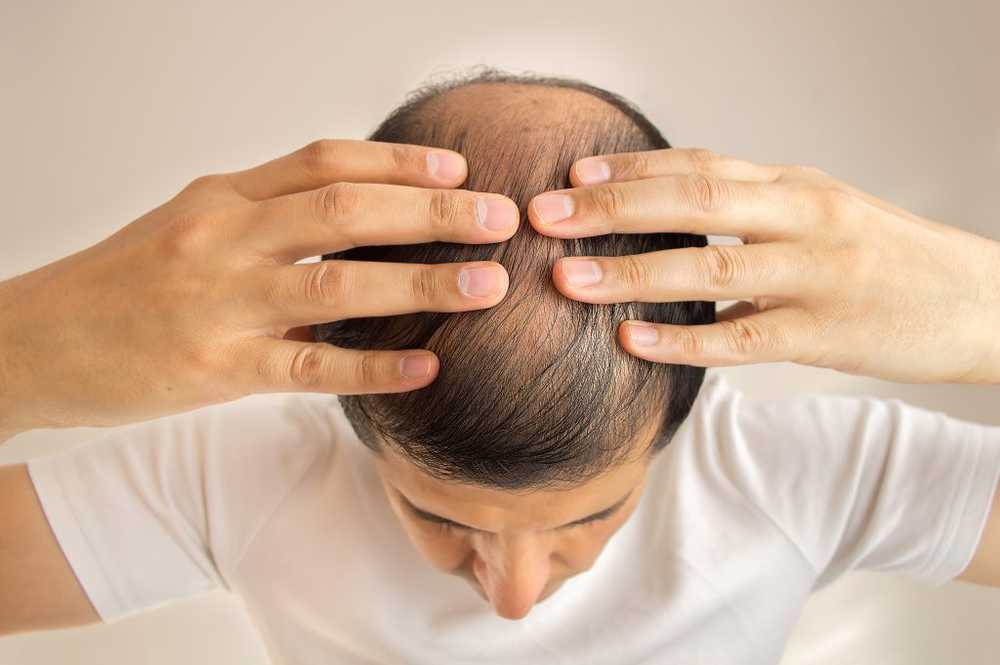 Hair Loss - causes, therapy and effective home remedies