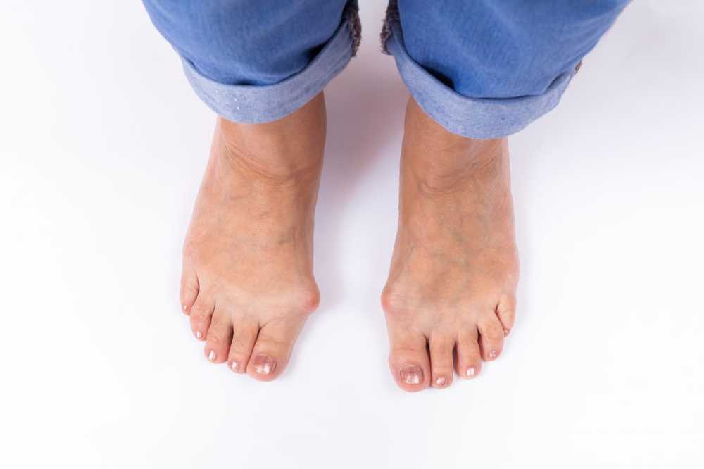 Hallux valgus - ball toes What helps against pain and deformed toes? / Health News