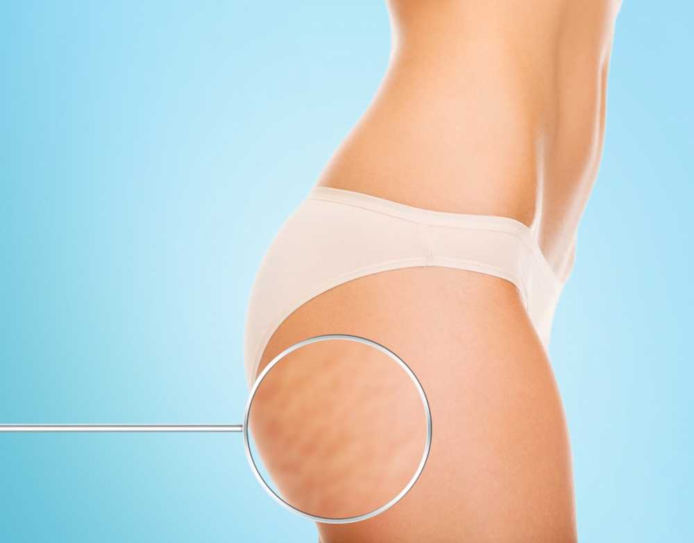 Home remedies for cellulite / 