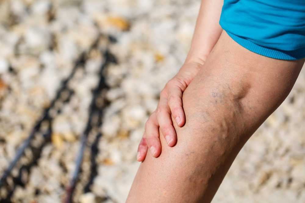 Home remedies for varicose veins / 