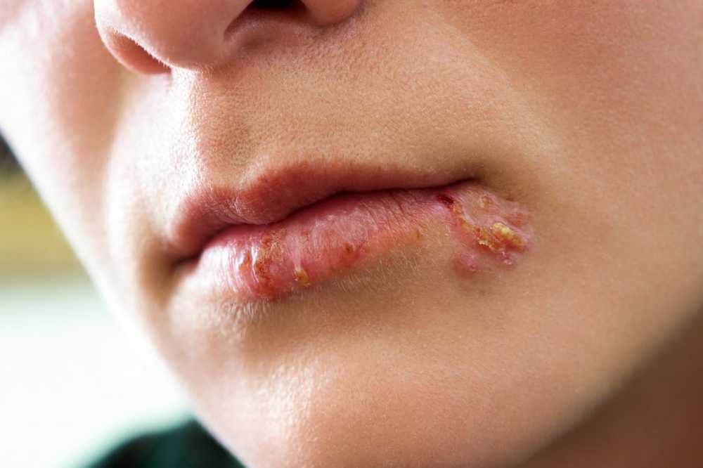 Herpes in bocca - innesco e trattamento