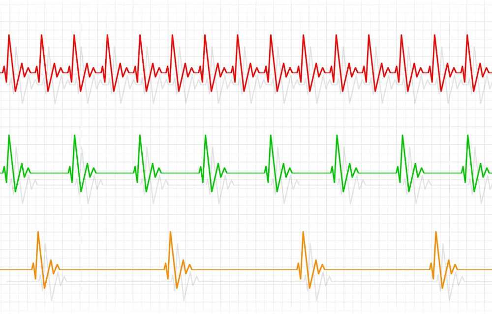 Tachycardia - tachycardia causes, treatment and self-help