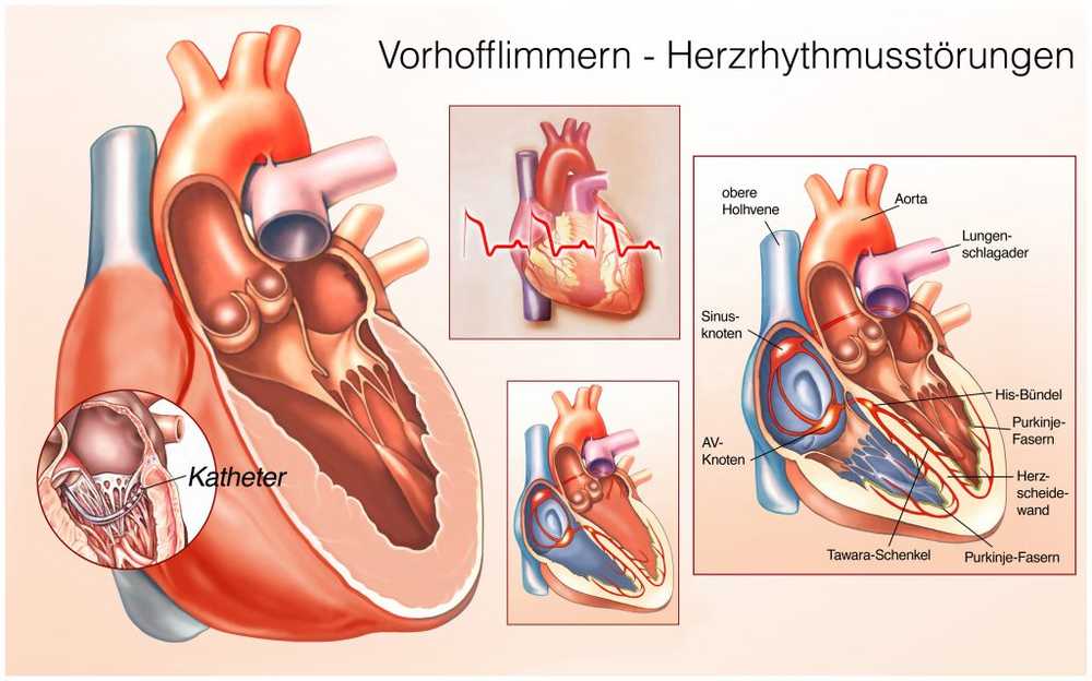 Cardiac arrhythmias New healing therapy for atrial fibrillation / Health News