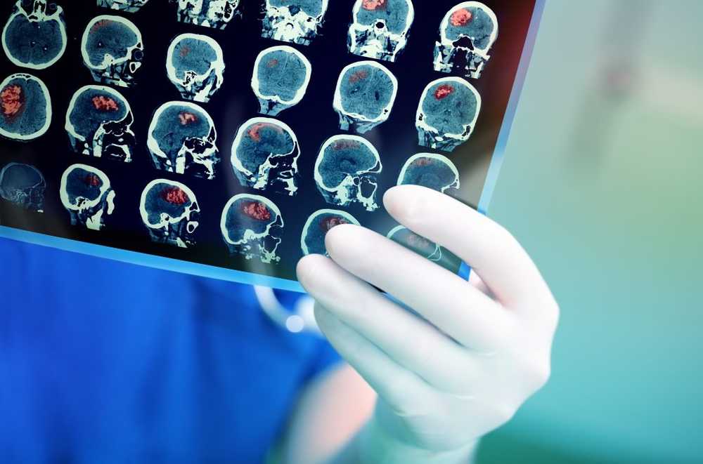 Brain tumor most common cause of death in childhood tumors / Health News