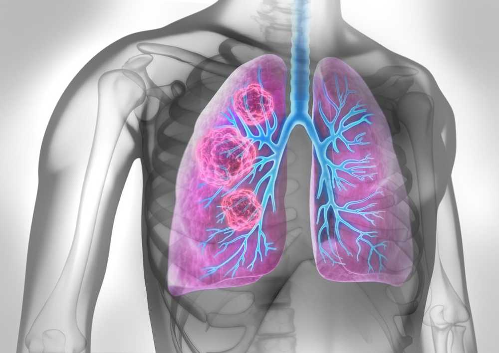 High pressure league voices objections In lung cancer and high blood pressure drugs related? / Health News