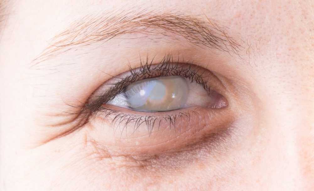Korneal inflammation i ögonen (keratit) / sjukdomar