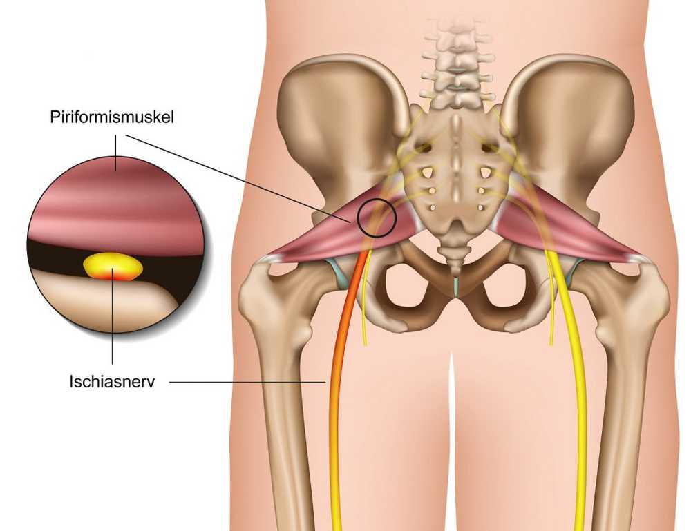 Sciatic pain - sciatic discomfort / symptoms