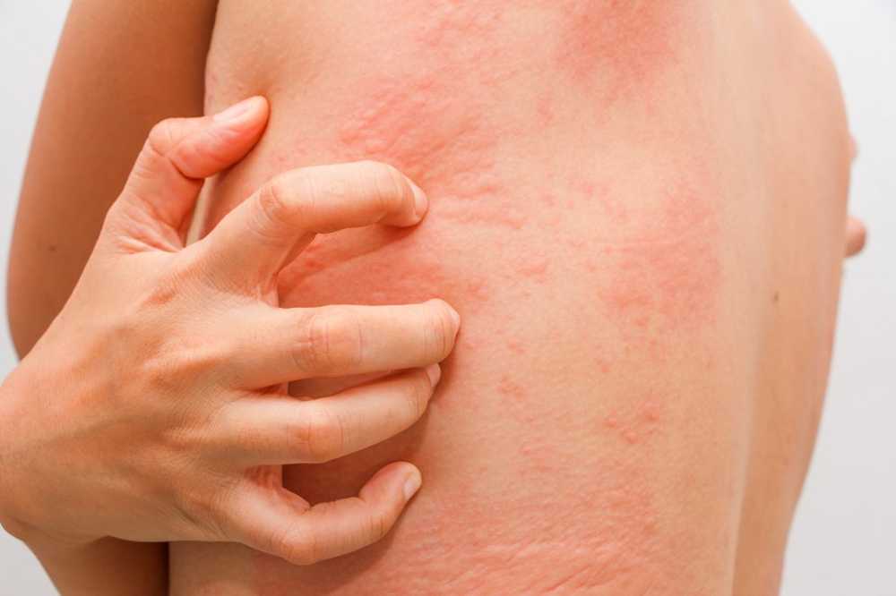 Itching and red pustules In a sun allergy, UV light therapy can help / Health News