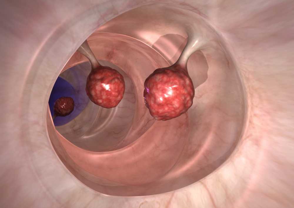 Les suppléments de calcium augmentent le risque de cancer colorectal / Nouvelles sur la santé