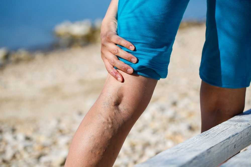 No pure beauty problem When varicose veins endanger our health