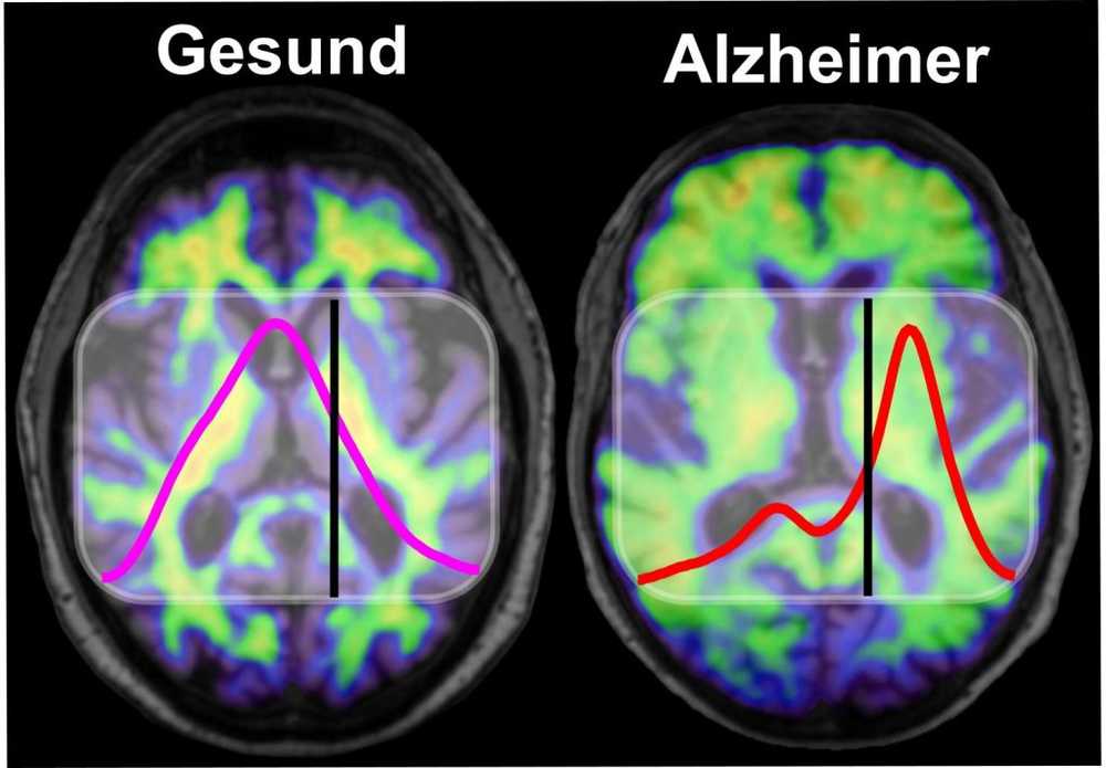 AI herkent de ziekte van Alzheimer al zes jaar voor de diagnose door artsen / Gezondheid nieuws